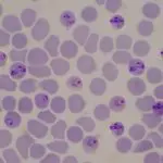 Malaria infected blood cells: Photo 214528878 © Chirawan Somsanuk | Dreamstime.com