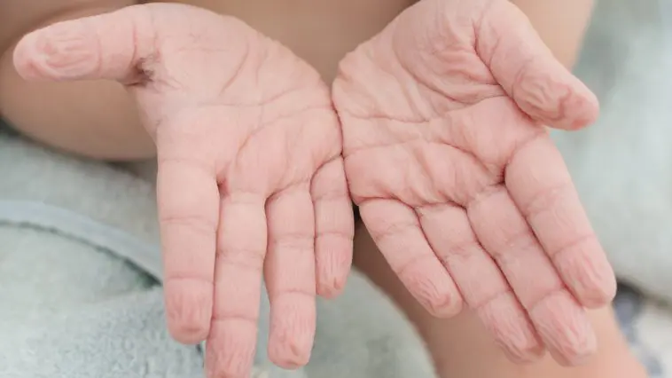 Wet, wrinkled palms and fingers: ID 194128816 © Anna Pecherskaia | Dreamstime.com