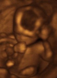 A 3D ultrasound of a baby at 17 weeks.