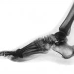 Inverted color normal foot X-ray:ID 96750399 © Puwadol Jaturawutthichai | Dreamstime.com