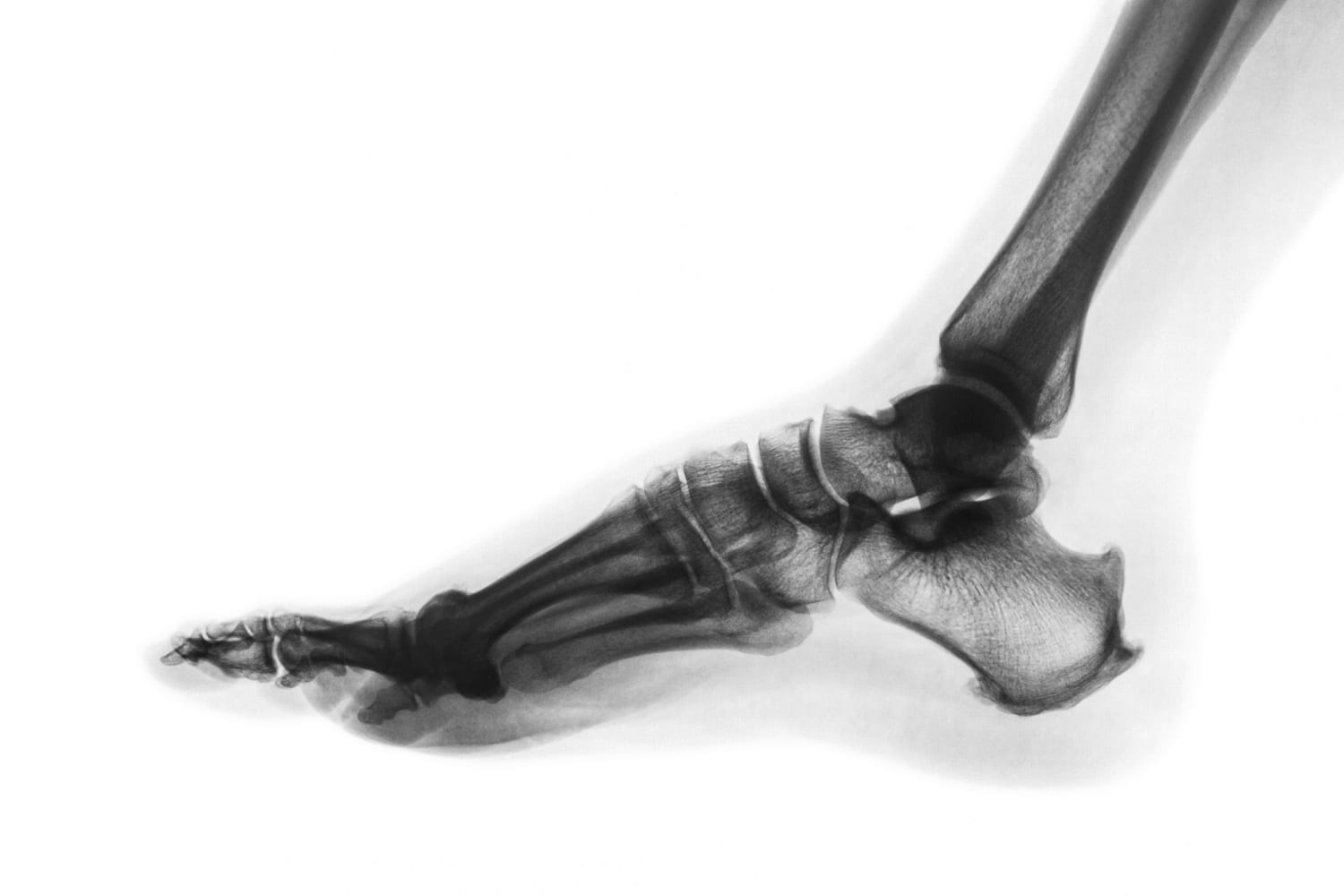 Inverted color normal foot X-ray:ID 96750399 © Puwadol Jaturawutthichai | Dreamstime.com