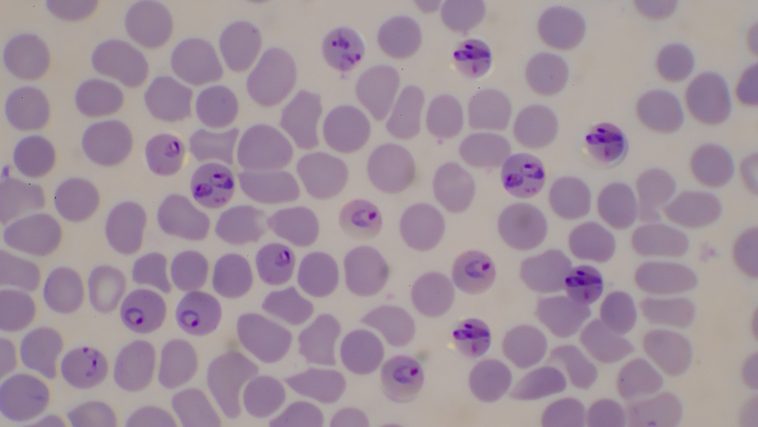 Malaria infected blood cells: Photo 214528878 © Chirawan Somsanuk | Dreamstime.com